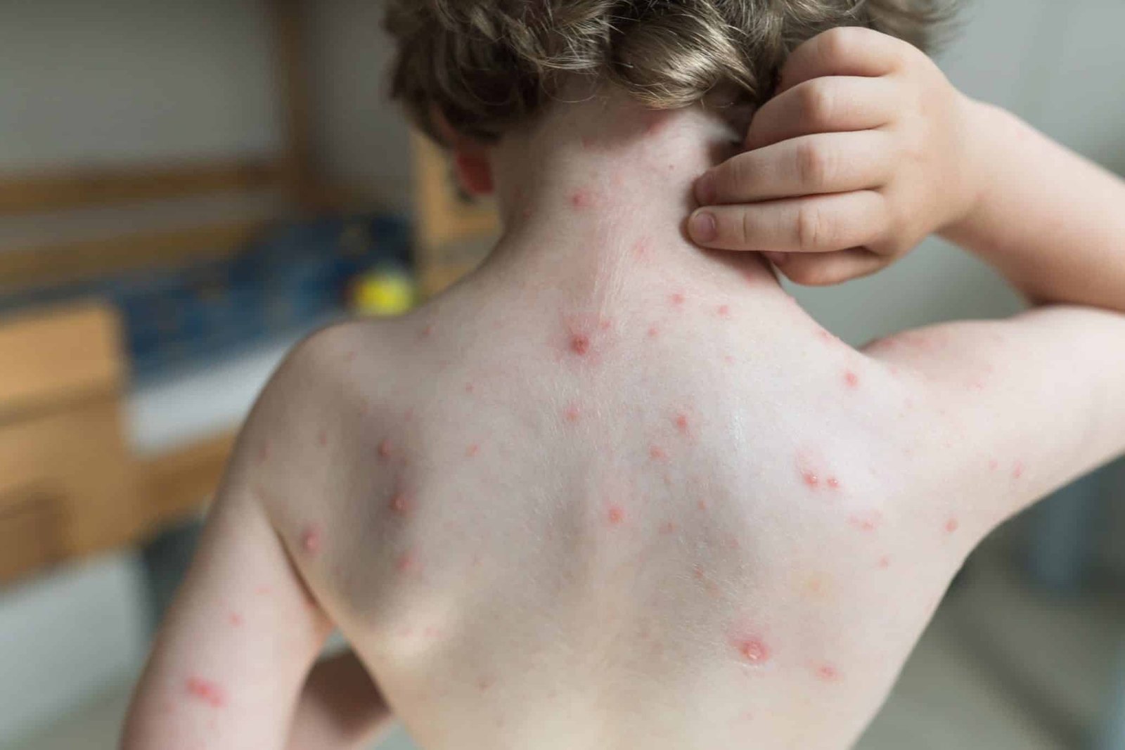 Skin Conditions